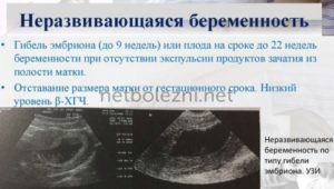 Неразвивающаяся беременность 8-9 недель, гистология