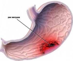 Образования в желудке
