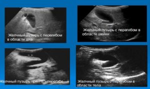 Перегиб желчного пузыря, гомогенная полость