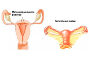Гипоплазия матки, СИЯ под вопросом, дисфункция яичников