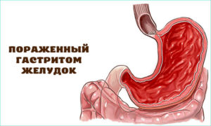 Панкреатит, холецистит, гастрит