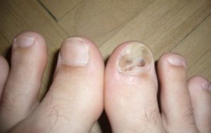 Не проходит гематома под ногтем большого пальца ноги