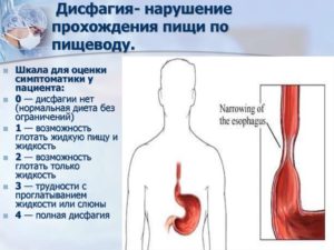 Непроходимость пищи и воды при глотании у пожилой женщины