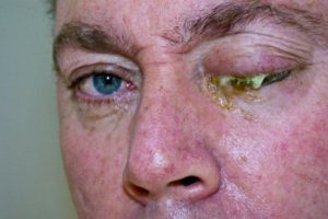 Осложнение на глаза при инфекционных болезнях