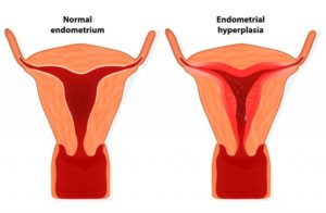 Гиперплазия эндометрия и эндометриоз