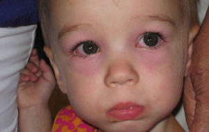 Опух левый глаз у ребенка