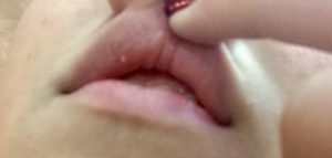 Небольшое уплотнение на большой половой губе с внешней стороны