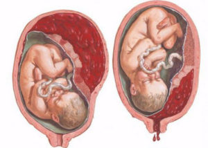 Отслойка плаценты смерть ребенка в 38 недель