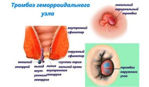 Образовалась шишка с черной точкой, наружный геморой