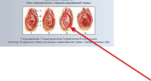 Неполная дефлорация