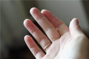 Облазит кожа на подушечках пальцев рук
