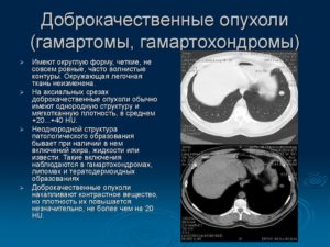 Нужна ли операция по результатам КТ. Пугает название мягкотканный компонент