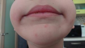 Небольшая сыпь на подбородке и у носа у ребенка 7 лет