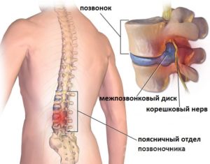 Отсутствует один позвонок в поясничном отделе