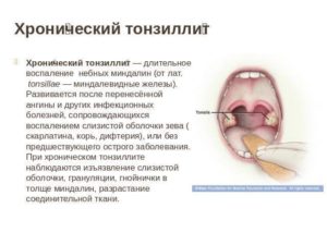 Головная боль отдает в зубы при хроническом тонзиллите