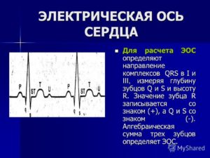 Неопределенная фронтальная ось QRS на экг