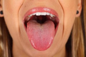Онемение, щипание и чувство обожженного языка, нёба и гортани