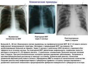 Нужно ли делать повторную флюрографию. Орви или сново пневмония