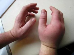 Опухают ладони и не только они