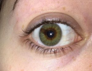 Гетерохромия, потемнение белка глаза