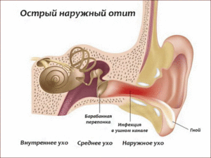 Не проходит средний отит