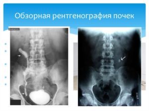 Нужен ли рентген почек при цистите