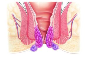 Не проходит геморроидальный узел