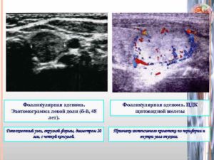 Гипертрофия левой доли щитовидной железы и узлы
