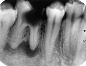 Гранулема на постоянном зубе у ребенка