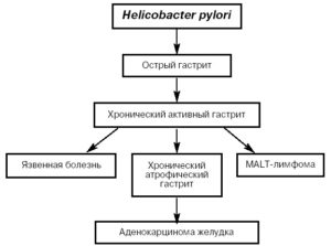 Хеликобактер пилори у ребенка 6 лет