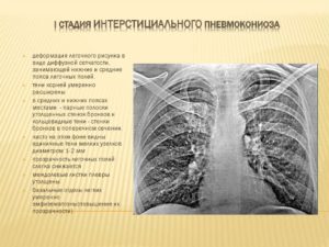 Фиброзная деформация легочного рисунка