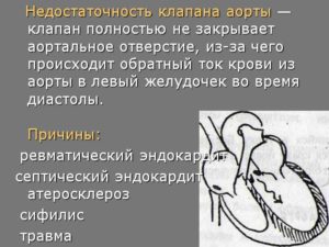 Недостаточность аортального клапана - насколько это страшно?