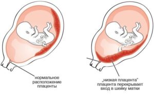 Низкая плацентация, ан. Тяж, беременность 31 неделя