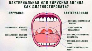 Головная боль отдает в зубы при хроническом тонзиллите