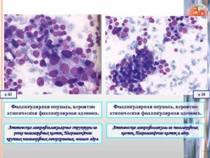 Нужна ли операция при атипии клеток щитовидной железы