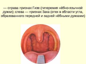 Гиперемия нежных дужек у ребенка