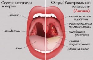 Одна миндалина красная и сильный кашель