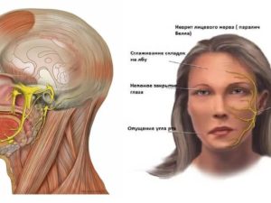 Нейропатия тройничного нерва и шейный хондроз