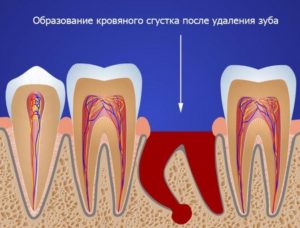 Флюс зуба. Температура после удаления зуба