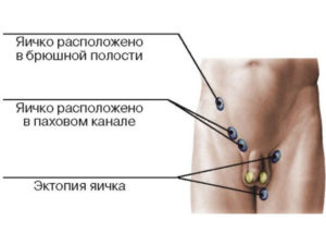 Не опустилось яичко у годовалого ребенка