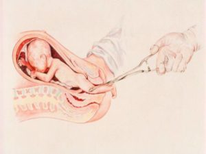 Остался живой плод после аборта, можно ли рожать