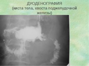 Образование в теле-хвосте поджелудочной