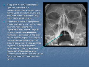 Гайморит и гемисинусит