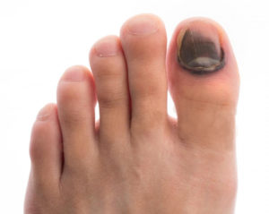 Не проходит гематома под ногтем большого пальца ноги