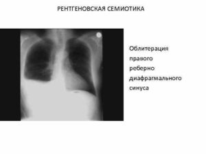 Передние кардиодиафоагмальные синусы облитерированы