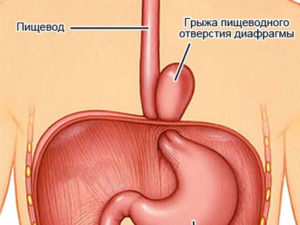 Грыжа пищевода 3-степени