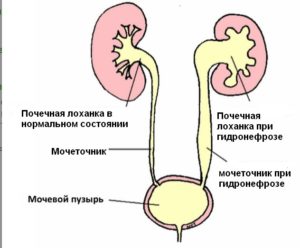 Гидронефроз при беременности