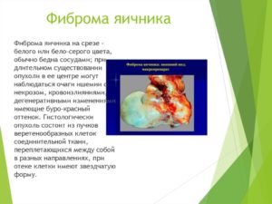 Фиброма яичника и онкомаркеры