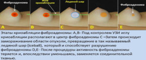 Фиброаденомы молочных желез, операция