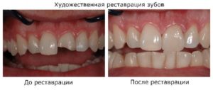 Ноет зуб после наращивания